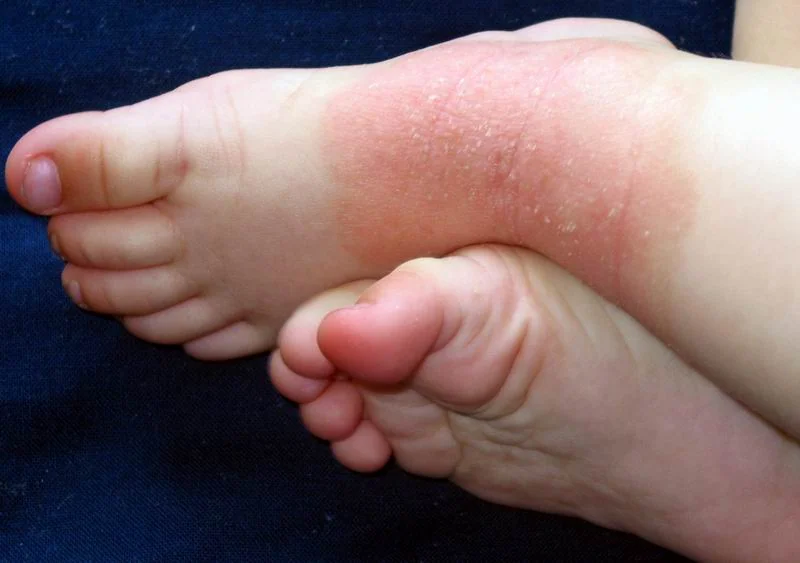 Neurodermitis-Behandlung: Vorher-Bild von trockener, juckender Haut am Fuß mit Neurodermitis vor der Anwendung von Silverlin Kolloidalem Silber.